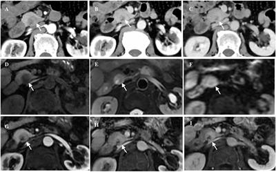 Imaging and histopathologic characteristics of typical pancreatic hamartoma: a case report and literature review